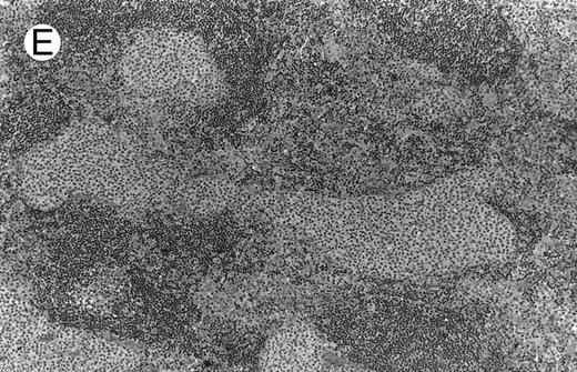 Fig. 1. NHL associated with SS (hematoxylin-eosin stains). (A) Case no. 13. Low-grade B-cell lymphoma of MALT type in the stomach, composed mainly of centrocyte-like cells with a few small lymphocytes and plasma cells. (B) Case no. 15. Low-grade B-cell lymphoma of MALT type in the parotid. Lymphoepithelial lesions are numerous, surrounded by centrocyte-like cells. (C) Case no. 6. Remnants of a germinal center in a low-grade B-cell lymphoma of MALT type in the parotid. / (D) Case no. 10. Immunocytoma in lymph node. The infiltrate is composed of small lymphocytes, plasma cells and blasts. (E) Case no. 14. Monocytoid B-cell lymphoma in a cervical lymph node with a monocytoid component located in dilated sinuses. / (F ) Case no. 2. High-grade B-cell lymphoma in the stomach (centroblastic lymphoma; upper), with remnants of low-grade lymphoma of MALT type (lower).
