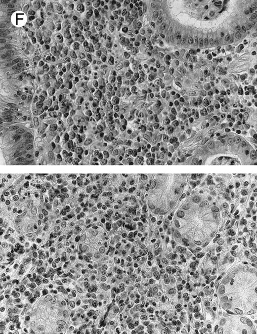 Fig. 1. NHL associated with SS (hematoxylin-eosin stains). (A) Case no. 13. Low-grade B-cell lymphoma of MALT type in the stomach, composed mainly of centrocyte-like cells with a few small lymphocytes and plasma cells. (B) Case no. 15. Low-grade B-cell lymphoma of MALT type in the parotid. Lymphoepithelial lesions are numerous, surrounded by centrocyte-like cells. (C) Case no. 6. Remnants of a germinal center in a low-grade B-cell lymphoma of MALT type in the parotid. / (D) Case no. 10. Immunocytoma in lymph node. The infiltrate is composed of small lymphocytes, plasma cells and blasts. (E) Case no. 14. Monocytoid B-cell lymphoma in a cervical lymph node with a monocytoid component located in dilated sinuses. / (F ) Case no. 2. High-grade B-cell lymphoma in the stomach (centroblastic lymphoma; upper), with remnants of low-grade lymphoma of MALT type (lower).
