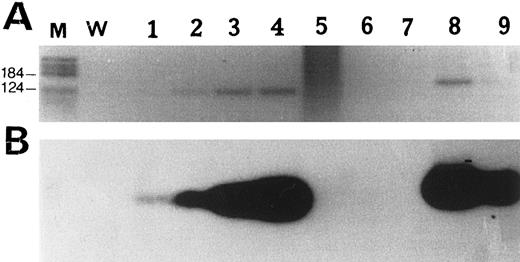 Fig. 2. PCR amplification of Bcl-2 rearrangement at the Mbr. (A) Reverse view of an ethidium bromide-stained agarose gel. (B) Southern blot analysis of PCR products hybridized with an internal Mbr oligoprobe (see Materials and Methods). M, molecular weight marker V (Boehringer Mannheim, Meylan, France); W, negative control (water). Lanes 1 through 4, positive control diluted 10−5 to 10−2; lane 5, case no. 2; lane 6, case no. 13; lane 7, case no. 16; lanes 8 and 9, case no. 5, detection of a Bcl-2 rearrangement both in the bronchic MALT lymphoma (lane 8) and in the nodal large B-cell lymphoma (lane 9) occurring 2 years later.