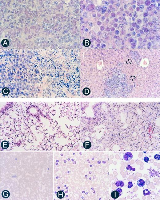 Fig. 6. Pathohistological features of the tissues of SCID mice engrafted with the transformed Tax-transgenic F8 LGL cell line. (A) Section of a peritoneal tumor located at the site of injection, showing that it is comprised primarily of LGLs (original magnification × 720). (B) Section of a mesenteric lymph node showing massive LGL infiltration, characteristic of diffuse large-cell type lymphoma (original magnification × 1,080). (C) Section of a spleen showing infiltration of LGLs in the left portion with generalized disruption of both the white and red pulp (original magnification × 720). (D) Section of a liver showing infiltration of LGLs into the sinusoid and portal region (open arrows; original magnification × 360). (E) Section of a mock-injected SCID lung showing an intrapulmonary bronchus with associated epithelium and normal alveolar ducts and alveoli (original magnification × 360). (F ) Lung section from an LGL-engrafted SCID mouse showing massive infiltration of LGLs into the bronchus epithelium and alveoli septa (original magnification × 360). (G) Peripheral blood smear from a mock-injected SCID mouse showing a paucity of circulating lymphocytes and neutrophils (original magnification × 360). (H) Peripheral blood smear from an LGL-engrafted SCID mouse demonstrating LGL lymphocytosis and neutrophilia (original magnification × 720). (I) Higher magnification of (H) showing morphologic characteristics of the LGLs (original magnification × 2,100).