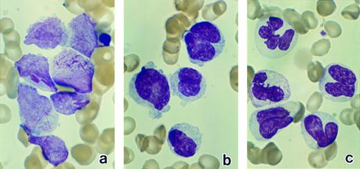 Fig. 1. Bone marrow leukemic cells in patient no. 1 at diagnosis (a), after 1 week of ATRA treatment (b), and after 3 weeks of ATRA treatment (c). (Original magnification × 330.)