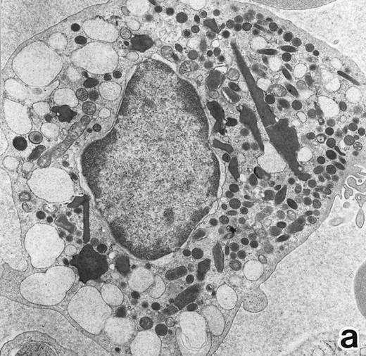 Fig. 2. (a) A bone marrow leukemic cell in patient no. 1 at diagnosis containing abundant abnormally shaped primary granules, including Auer rods and Chediak-Higashi–type inclusions. Dilatation of rER is remarkable. (Original magnification × 10,800.) (b) Higher magnification of a cytoplasmic inclusion body of another cell in patient no. 1 that is membrane-bound and contains bundles of filamentous structures, similar to Auer rods. (Original magnification × 25,800.)