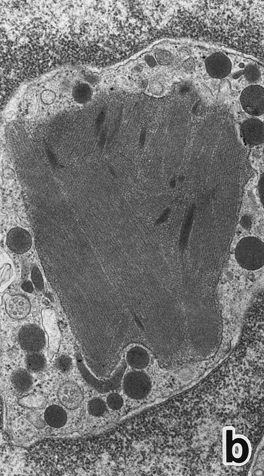 Fig. 2. (a) A bone marrow leukemic cell in patient no. 1 at diagnosis containing abundant abnormally shaped primary granules, including Auer rods and Chediak-Higashi–type inclusions. Dilatation of rER is remarkable. (Original magnification × 10,800.) (b) Higher magnification of a cytoplasmic inclusion body of another cell in patient no. 1 that is membrane-bound and contains bundles of filamentous structures, similar to Auer rods. (Original magnification × 25,800.)