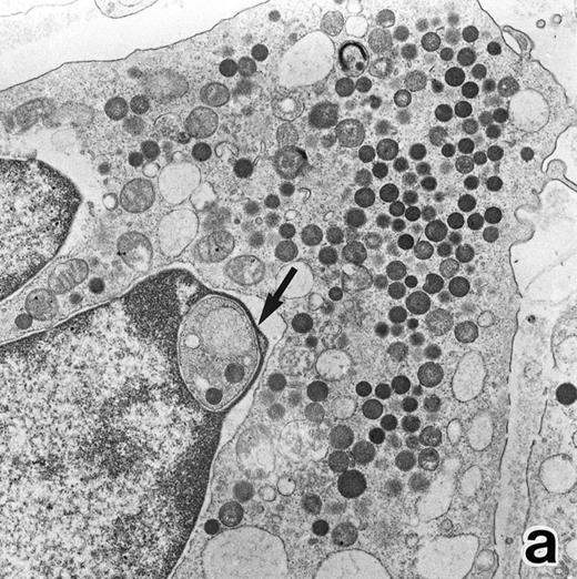 Fig. 3. (a) A PMN in patient no. 1 after 1 week of ATRA treatment. Lobulated nuclei with a nuclear bleb (arrow) is seen. rERs are still dilated. Note that the primary granules have become normal in both size and shape and that neither Auer rods nor irregularly shaped inclusion bodies are seen in this cell. (Original magnification × 16,900.) (b) Higher magnification of the cytoplasm of another cell in patient no. 1, showing a structure in which a spherical primary granule (arrow) and an Auer rod are coupled. (Original magnification × 40,000.)