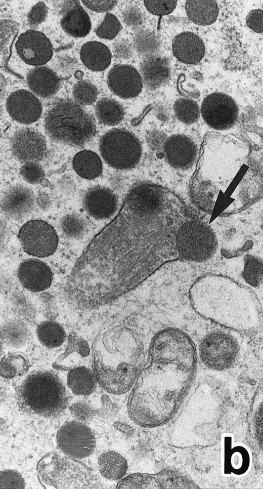 Fig. 3. (a) A PMN in patient no. 1 after 1 week of ATRA treatment. Lobulated nuclei with a nuclear bleb (arrow) is seen. rERs are still dilated. Note that the primary granules have become normal in both size and shape and that neither Auer rods nor irregularly shaped inclusion bodies are seen in this cell. (Original magnification × 16,900.) (b) Higher magnification of the cytoplasm of another cell in patient no. 1, showing a structure in which a spherical primary granule (arrow) and an Auer rod are coupled. (Original magnification × 40,000.)