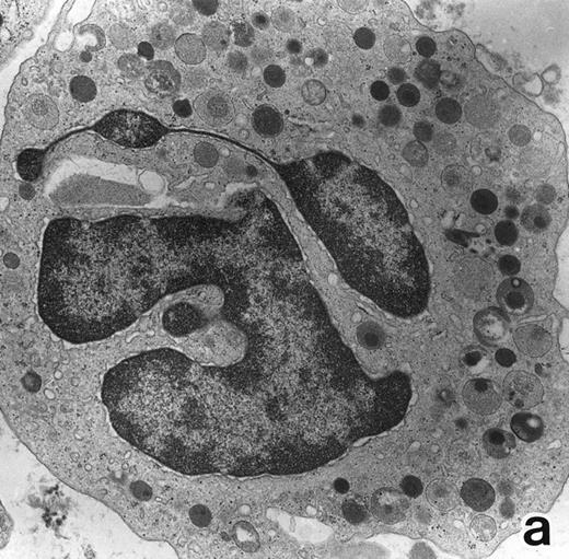 Fig. 4. (a) A PMN in patient no. 2 after 10 days of ATRA treatment. The nuclei are irregularly lobulated, with some of them being connected by nuclear filamentous structures, and heterochromatin is condensed along the nuclear membrane. (Original magnification × 13,100.) (b) Higher magnification of a portion of the cell in (a). The cytoplasmic granules are large and spherical, and some of them contain flocculent material and central cores with higher electron density. (Original magnification × 20,200.)