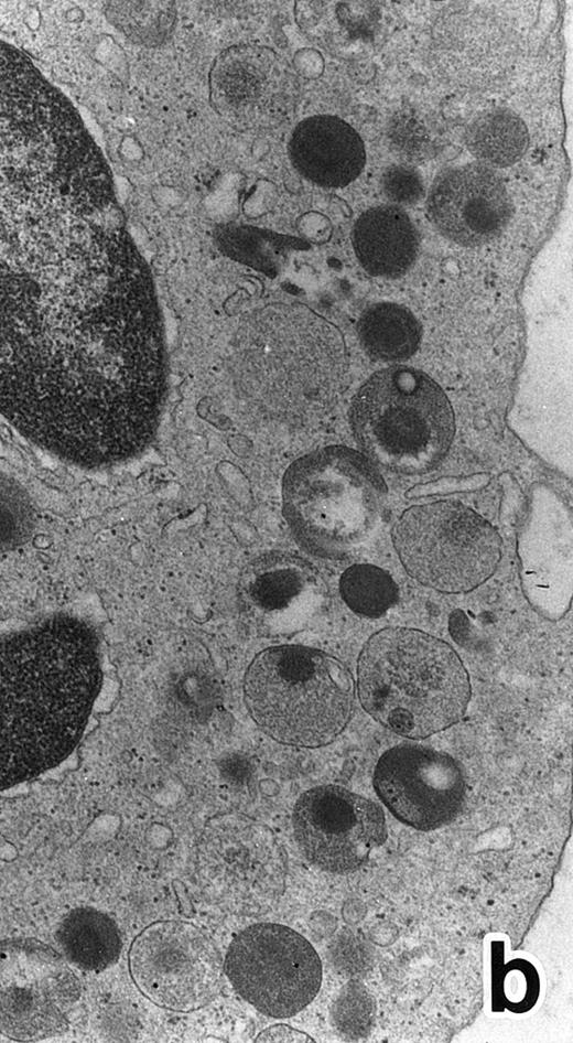 Fig. 4. (a) A PMN in patient no. 2 after 10 days of ATRA treatment. The nuclei are irregularly lobulated, with some of them being connected by nuclear filamentous structures, and heterochromatin is condensed along the nuclear membrane. (Original magnification × 13,100.) (b) Higher magnification of a portion of the cell in (a). The cytoplasmic granules are large and spherical, and some of them contain flocculent material and central cores with higher electron density. (Original magnification × 20,200.)