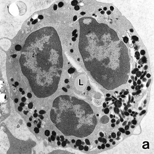 Fig. 5. (a) A PMN in patient no. 1 that appeared in the bone marrow after 3 weeks of ATRA treatment. There are numerous granules in the cytoplasm, including spherical, elongated, and even dumbell-shaped granules, all of which are MPO-positive, ie, primary granules. A lipid droplet (L) is also present. (MPO-stained section, original magnification × 15,200.) (b) Higher magnification of a portion of the cytoplasm in (a). MPO-negative secondary granules are not seen. (MPO-stained section, original magnification × 30,900.)