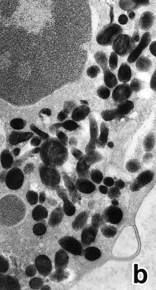 Fig. 5. (a) A PMN in patient no. 1 that appeared in the bone marrow after 3 weeks of ATRA treatment. There are numerous granules in the cytoplasm, including spherical, elongated, and even dumbell-shaped granules, all of which are MPO-positive, ie, primary granules. A lipid droplet (L) is also present. (MPO-stained section, original magnification × 15,200.) (b) Higher magnification of a portion of the cytoplasm in (a). MPO-negative secondary granules are not seen. (MPO-stained section, original magnification × 30,900.)