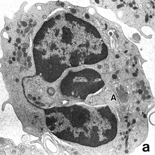 Fig. 6. (a) A PMN in patient no. 1, seen in the bone marrow after 3 weeks of ATRA treatment. Lobulated nuclei are connected by nuclear filamentous structures and heterochromatin is highly condensed along the nuclear membrane. An Auer rod (A) is present along with primary granules. (Original magnification × 16,900.) (b) Higher magnification of the cytoplasm of a PMN in patient no. 3 after 3 weeks of ATRA treatment. Auer rods and cytoplasmic granules are all positive for MPO, and no MPO-negative secondary granules are evident. (MPO-stained section, original magnification × 41,900.)