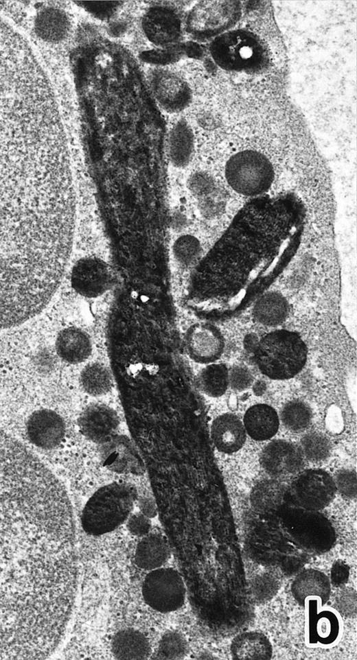 Fig. 6. (a) A PMN in patient no. 1, seen in the bone marrow after 3 weeks of ATRA treatment. Lobulated nuclei are connected by nuclear filamentous structures and heterochromatin is highly condensed along the nuclear membrane. An Auer rod (A) is present along with primary granules. (Original magnification × 16,900.) (b) Higher magnification of the cytoplasm of a PMN in patient no. 3 after 3 weeks of ATRA treatment. Auer rods and cytoplasmic granules are all positive for MPO, and no MPO-negative secondary granules are evident. (MPO-stained section, original magnification × 41,900.)