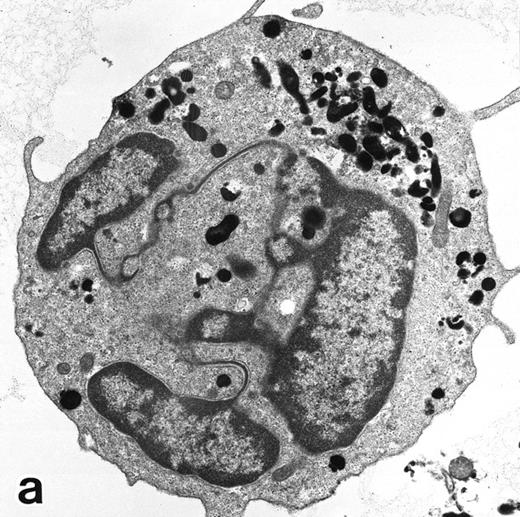 Fig. 8. (a) A PMN that emerged in the APL cell culture of patient no. 3 in the presence of ATRA for 1 week. From the lobulated nuclear configurations and condensed heterochromatin, this cell looks like a PMN. However, the cytoplasm contains many MPO-positive primary granules but no secondary granules. (MPO-stained section, original magnification × 14,900.) (b) Higher magnification of a portion of the cell in (a), showing that the cytoplasmic granules are all MPO-positive. (MPO-stained section, original magnification × 30,100.)