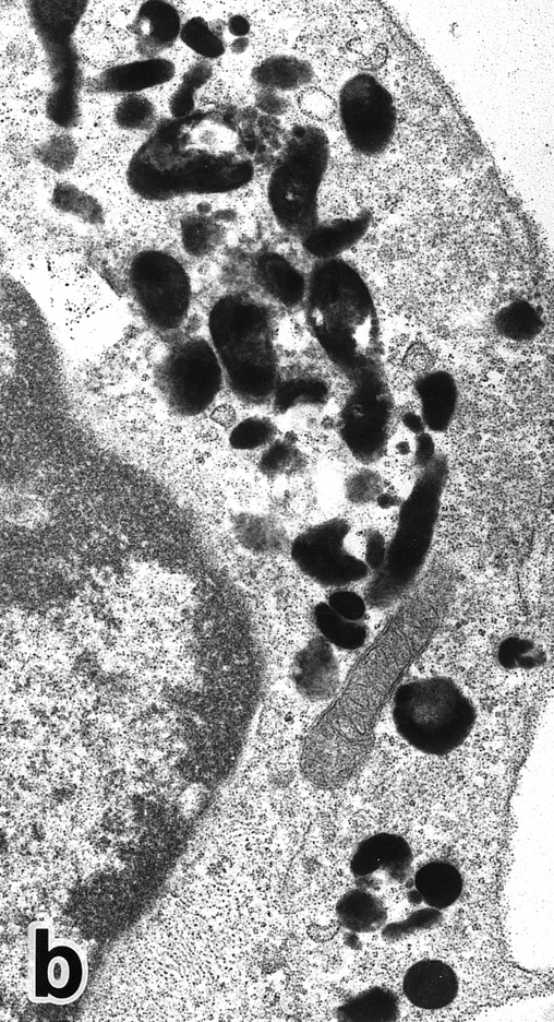 Fig. 8. (a) A PMN that emerged in the APL cell culture of patient no. 3 in the presence of ATRA for 1 week. From the lobulated nuclear configurations and condensed heterochromatin, this cell looks like a PMN. However, the cytoplasm contains many MPO-positive primary granules but no secondary granules. (MPO-stained section, original magnification × 14,900.) (b) Higher magnification of a portion of the cell in (a), showing that the cytoplasmic granules are all MPO-positive. (MPO-stained section, original magnification × 30,100.)