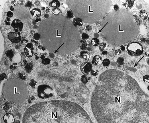 Fig. 9. Representative appearance of a portion of a PMN that appeared in a culture of nonleukemic bone marrow mononuclear cells incubated in the presence of ATRA for 1 week. Both MPO-positive and -negative (arrow) cytoplasmic granules are present, with the former outnumbering the latter. Large spherical lipid droplets (L) are also present. N, nucleus. (MPO-stained section, original magnification × 17,700.)