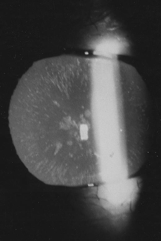 Fig. 3. Slit-lamp examination of the lens in the proband of family 2. Multiple spots are visible in the lens core.
