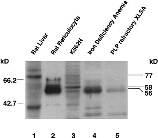 Fig. 3. Immunoblot analysis of ALAS-E protein in bone marrow cells of a pyridoxine-refractory XLSA patient. Expression of ALAS-E in rat reticulocytes and human bone marrow erythroid cells was analyzed with a rabbit antirat ALAS-N polyclonal antibody. Lanes 1 and 2 are loaded with a cytosolic fraction of rat liver and a whole homogenate of rat reticulocytes, respectively. A 77-kD precursor form of ALAS-N is detected in rat liver (lane 1, upper band), and the mature form of ALAS-E in rat reticulocytes (lane 2). Lane 3 contains a mitochondrial fraction of K562H cells and human ALAS-E can be detected (lane 3). Lanes 4 and 5 are loaded with a whole homogenate of bone marrow cells. Normal levels of ALAS-E are present in the bone marrow cells of an iron deficiency anemia patient (lane 4), but only about 5% of the level of normal controls are detectable in those of a pyridoxine-refractory XLSA patient (lane 5).