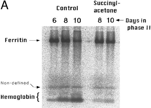 Fig. 3. Effect of inhibition of heme synthesis on intracellular radio-iron distribution during erythroid development. Cells were labeled with 59Fe-human–diferric transferrin during the first 6 days of phase II (EPO-dependent phase, see Materials and Methods), then washed, and reincubated in fresh nonradioactive medium with or without 0.5 mmol/L succinylacetone. (A) Analysis by SDS-PAGE. Equal amounts of cell lysate radioactivity were applied to each lane of a 6% nonreducing SDS-PAGE gel followed by phosphor-imaging. The figure represents a typical result of four independent experiments from four different donors. (B) Analysis by immunoprecipitation and heme extraction. Ferritin was immunoprecipitated from cell lysates with antihuman placental ferritin rabbit serum. Heme was extracted with an ethylacetate-acetic acid (3:1 vol/vol) mixture. The results shown are from cultures of two different normal donors. Both experiments were performed in duplicate.