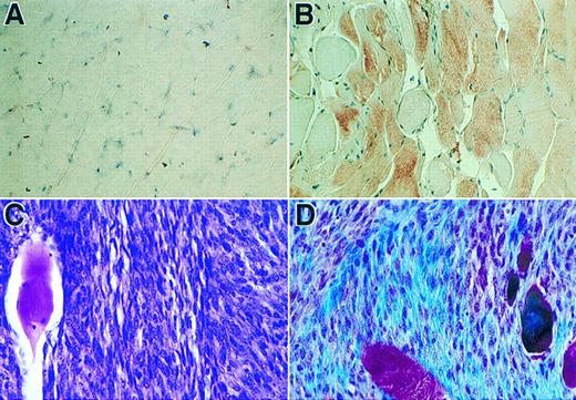 Fig. 8. Immunohistochemical analyses of sections of muscle tissue and a spontaneous tumor. (A) Tissue section of muscle with no cell injection. (B) Tissue section of muscle received myoblasts carrying pdLMe4βAhIXm1. Tissue sections in panels A and B were stained with hFIX monoclonal antibody followed by counter-staining with hemotoxylin (×630). Brownish-red color indicates the presence of hFIX. (C) Section of the tumor from a group 4 mouse stained with H & E (×500). The fibrosarcoma cells are small and spindle-shaped; one large muscle fiber is on the left. (D) Tumor section stained with Masson trichrome shows small spindled cells of fibrosarcoma and the collagen produced by the neoplasm in blue color; several muscle fibers are red or purple-red in color and large in size (×500).