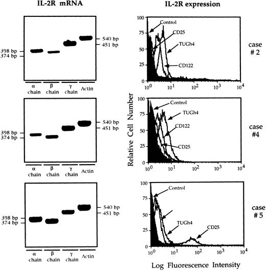 Fig. 1. RT-PCR analysis of the expression of the messages for the α, β, γ IL-2R, and flow cytometry analysis of IL-2R complex expression by BAL T cells isolated from three representative patients with HIV infection. Patients' T cells expressed the messages for the α, β, and γ IL-2R chains. The limited number of T cells available from the BAL of normal subjects prevented the evaluation of the IL-2R messages. In patients with AIDS the CD122 histograms were completely shifted with respect to the control histograms, indicating that the entire T-cell population expresses the IL-2Rβ chain. The γc was constitutively expressed while the α chain was expressed by a discrete percentage of lung T cells from case no. 5 (11%).