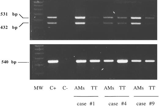 Fig. 2. RT-PCR analysis of the expression of the messages for the IL-15Rα chain and control β-actin in lung T cells and alveolar macrophages (AMs). Lane 1, molecular weight (MW) marker (molecular weight VI-digested); lane 2, positive control (C+) (PBMCs stimulated for 12 hours with phytohemagglutinin, 5 μg/mL); lane 3, the negative control (C−) (sample without cDNA); lanes 4 to 9, alveolar macrophages and lung T cells isolated from three representative patients with HIV infection (cases no. 1, 4, and 9 in Table 1). A faint expression of IL-15Rα chain mRNA was detectable by RT-PCR in purified lung T cells while alveolar macrophages bore higher levels of IL-15Rα chain mRNA at the transcript level.