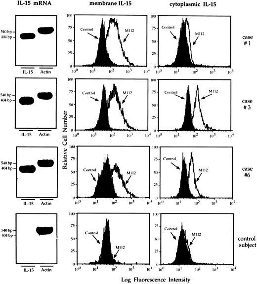 Fig. 5. RT-PCR analysis of the expression of IL-15 message and flow cytometry analysis of membrane and cytoplasmic expression of IL-15 by pulmonary macrophages recovered from three representative patients with HIV infection and high-intensity T-cell alveolitis and a control subject who showed a normal cell recovery (bottom series of panels). Highly purified alveolar macrophages retrieved from the patients showed a strong IL-15 message. Furthermore, they bore membrane – and cytoplasmic–IL-15, whereas alveolar macrophages retrieved from the normal individual did not.