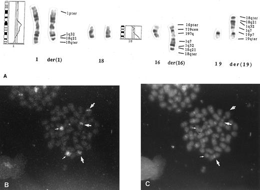 Fig. 2. Mechanism for BCL2 amplification in a diffuse large B-cell lymphoma. (A) Chromosome 18q–derived sequences were translocated to chromosome 1q32, which was further translocated to chromosomes 16 and 19 (case no. 6; Table 1). CGH profiles of chromosomes 1 and 18 are also shown. The karyotype is 48,X,–X,der(1),+3,del(6)(q12q22),+7,−16,+der(16),−19,+der(19),+r(?)×2, but only the chromosomes taking part in the translocations are described in the figure. The interpretation of the marker chromosomes was confirmed by painting, using probes specific for chromosomes 16, 18, and 19. (B) Fluorescence in situ hybridization using a chromosome 18-specific probe shows three labels (large arrows) in addition to normal chromosomes (small arrows). This shows that 18-derived material was translocated to three chromosomes. (C) DAPI (4,6-diamidino-2-phenylindole) and propidium iodide staining of the metaphase in (B).