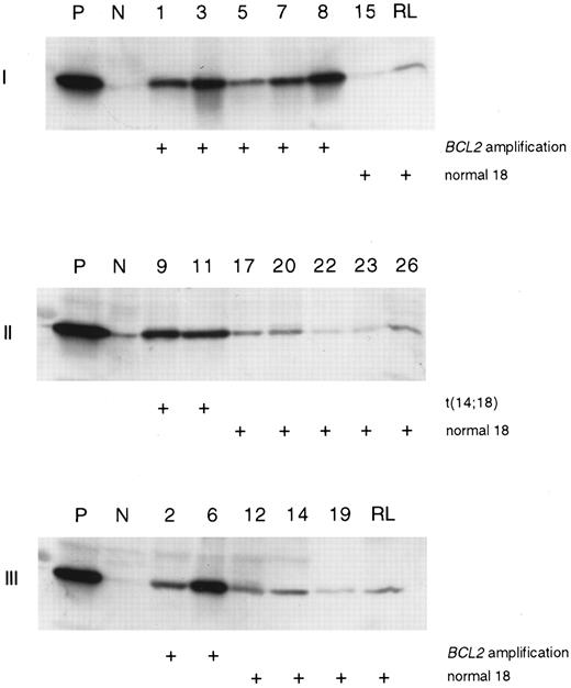 Fig. 4. BCL2 protein expression in diffuse large B-cell lymphoma. A Western immunoblot analysis was performed using a BCL2-specific monoclonal antibody. Lymphoma with t(14; 18) translocation was used as a positive control (P) and cases with loss of 18 (gels I and II) and normal 18 (gel III) were used as negative controls (N). The samples loaded to each gel are marked on the top of the figures. Protein from reactive lymphatic tissue (RL) was added to two gels (I and III).