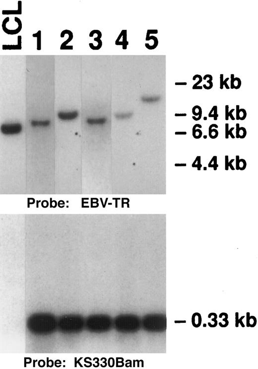 Fig. 1. Southern blot analyses for EBV terminal repeat and KSHV. DNA samples were digested with the BamHI restriction enzyme and hybridized to the BamHI NJ-het probe (upper panel) and to the KS330Bam probe (lower panel). UH1, an established LCL, was used as a positive control for EBV and as a negative control for KSHV. The number above each lane corresponds to the PEL case.