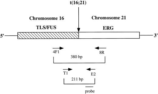 Fig. 1. Schematic diagram of the t(16; 21)-specific chimeric transcript and the location of the oligonucleotide primers and probe used for the RT-PCR and Southern blot analysis. The sizes of the products amplified by the two sets of primers are indicated.