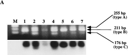 Fig. 3. RT-PCR and Southern blot analysis of the TLS/FUS-ERG chimeric transcripts in patients with t(16; 21)-AML. M, Marker, φX174 HaeIII. The sizes of the transcripts are indicated. The hybridized products were located beneath the corresponding samples. (A) Consistent detection of the transcripts in patient 2. Three types of transcripts (types A, B, and C) were detectable in the samples at the stages of MDS (lane 1), diagnosis of AML (lane 2), CR (4, 7, and 9 months, respectively, after diagnosis of AML, lanes 4 through 6) and relapse (10.5 months after diagnosis, lane 7). A faint transcript of 211 bp (type B) was found in one sample in CR (3 months after diagnosis, lane 3). (B) RT-PCR analysis of the TLS/FUS-ERG gene in patients 8, 19, and 10. Three sized TLS/FUS-ERG chimeric transcripts (type A, B, and C) were noted in the positive control, UTP-12 (lane 1) and all of the sequential samples available at diagnosis (lane 2), CR (lane 3), and relapse (lane 4) in patient 8. A novel sized transcript (type D) was found in patient 19 at diagnosis (lane 5). The results of patient 10 are indicated in lanes 6 through 9: lane 6, at diagnosis; lanes 7 through 9, in CR 6, 11, and 15 months after diagnosis.