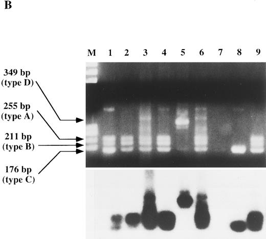 Fig. 3. RT-PCR and Southern blot analysis of the TLS/FUS-ERG chimeric transcripts in patients with t(16; 21)-AML. M, Marker, φX174 HaeIII. The sizes of the transcripts are indicated. The hybridized products were located beneath the corresponding samples. (A) Consistent detection of the transcripts in patient 2. Three types of transcripts (types A, B, and C) were detectable in the samples at the stages of MDS (lane 1), diagnosis of AML (lane 2), CR (4, 7, and 9 months, respectively, after diagnosis of AML, lanes 4 through 6) and relapse (10.5 months after diagnosis, lane 7). A faint transcript of 211 bp (type B) was found in one sample in CR (3 months after diagnosis, lane 3). (B) RT-PCR analysis of the TLS/FUS-ERG gene in patients 8, 19, and 10. Three sized TLS/FUS-ERG chimeric transcripts (type A, B, and C) were noted in the positive control, UTP-12 (lane 1) and all of the sequential samples available at diagnosis (lane 2), CR (lane 3), and relapse (lane 4) in patient 8. A novel sized transcript (type D) was found in patient 19 at diagnosis (lane 5). The results of patient 10 are indicated in lanes 6 through 9: lane 6, at diagnosis; lanes 7 through 9, in CR 6, 11, and 15 months after diagnosis.