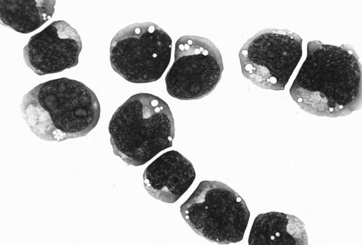 Fig. 2. Cytospin preparation of Katata cells closely resembling the original lymphoma cells. May-Grünwald-Giemsa stain (OM × 1,000).