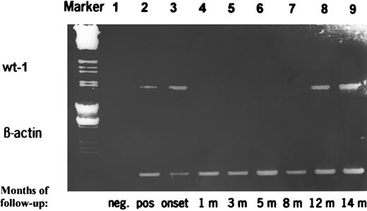 Fig. 6. RT-PCR products of wt1 during follow-up of a patient with AML achieving CR and who relapsed 14 months later. The PCR products were additionally quantitated by a competitive PCR. Marker, HindIII/EcoRI-digested λ DNA; lane 1, negative control; lane 2, positive control; lane 3, de novo AML at diagnosis (19.0371 fg wt1-specific mRNA/μg total RNA); lanes 4 through 7, AML in CR (wt1 mRNA <0.0001 fg/μg); lane 8, AML in clinical and morphological CR but positive PCR (quantitation due to limited amount of RNA not done); and lane 9, clinical and morphological relapse of AML (9.484 fg/μg).