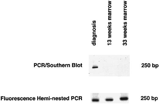 Fig. 2. Detection of MRD by both the heminested fluorescence PCR and the PCR/Southern blot assay 13 and 33 weeks after diagnosis for 1 representative patient with discordant results for MRD (no. CT11 in Tables 1 and 2).