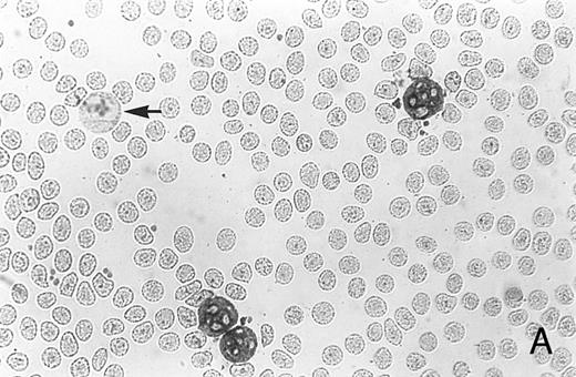 Fig. 1. Immunocytochemistry of blood and BM. (A) Blood smear from a healthy donor stained with MoAb AAA4 shows NAMLAA-positive granulocytes and an NAMLAA-negative monocyte (arrow). (B) BM smear after staining with AAA4 shows an NAMLAA-positive promyelocyte and a mature granulocyte, both NAMLAA-positive.