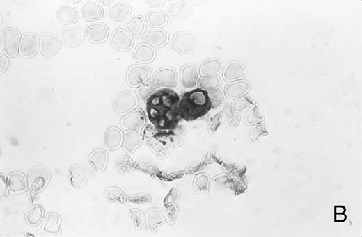 Fig. 1. Immunocytochemistry of blood and BM. (A) Blood smear from a healthy donor stained with MoAb AAA4 shows NAMLAA-positive granulocytes and an NAMLAA-negative monocyte (arrow). (B) BM smear after staining with AAA4 shows an NAMLAA-positive promyelocyte and a mature granulocyte, both NAMLAA-positive.