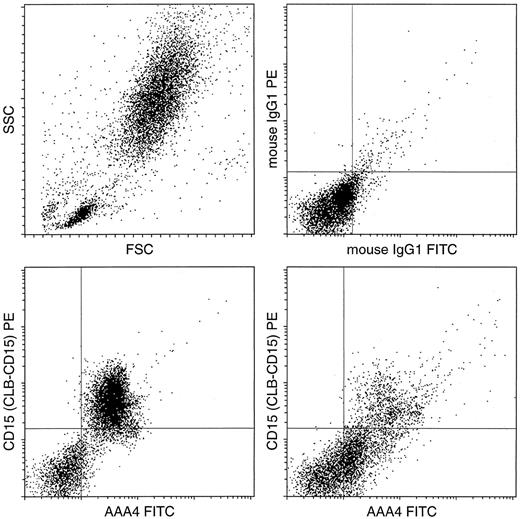Fig. 3. Flow cytometric analysis of BM from a healthy donor compared with an FAB-classified AML-M3 patient. Double labeling was performed with AAA4-FITC (NAMLAA specific) and CD15-PE. The scatter morphology of the BM sample and the control stainings with IgG-FITC and IgG-PE are given in the two upper plots. Double-labeling of BM cells with the antibody AAA4-FITC and the granulocyte marker CD15-PE shows that in the normal situation (lower left) the (immature) granulocytes are CD15 and NAMLAA double positive, whereas the AML cells are only positive for NAMLAA.