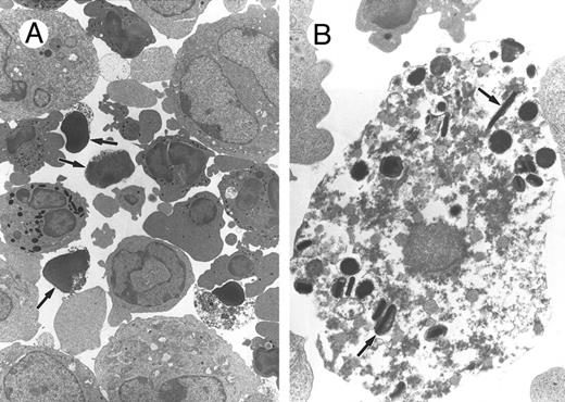 Fig. 1. Morphologic analysis of bone marrow cells treated with the MoAb anti-FcγR, 2.4G2. BM (2 × 105 cells/mL) was cultured for 24 hours with rGM-CSF (10 U/mL), rIL-3 (10 U/mL), and rIL-5 (20 U/mL) with 2.4G2 (25 μg/mL), and the morphology of the cells was analyzed by transmission electron microscopy. (A) Representative example of cells cultured in the presence of 2.4G2. Arrows indicate cells with apoptotic features. (B) Higher magnification of 1 apoptotic cell where the characteristic eosinophilic granules are still intact (arrows).