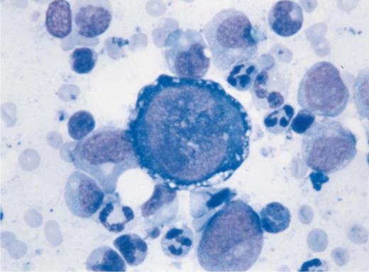 Pure red cell aplasia in a lung-transplant patient under immunosuppressive treatment. Bone marrow aspiration shows giant megaloblastic proerythroblasts containing nuclear inclusion bodies and vacuolization of the cytoplasm with absence of other erythroid precursors. Parvovirus B19 genome was found by polymerase chain reaction analysis of the bone marrow and peripheral blood. (Courtesy of Ph. Beris, MD, and K. Samii, MD, Division d'Hématologie, Hôpitaux Universitaires de Genève, Geneva 14, Switzerland.)