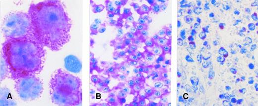 Fig. 1. CD138/B-B4 expression in AIDS-related extranodal NHLs with plasma cell differentiation. (A) HHV-8+ body cavity–based lymphoma. (B) Plasmablastic lymphoma. (C) “Intermediate” lymphoma. (A) cytospin preparation; APAAP (alkaline phosphatase anti-alkaline phosphatase) technique. Original magnification × 800. (B), (C) paraffin section; APAAP technique. Original magnification × 400.