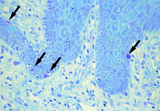 Fig. 1. Mast cells in the basal layer of the epidermis (arrow) (toluidine blue).