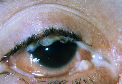 Fig. 1. Ligneous conjunctivitis with thickened everted eyelids (patient 1).