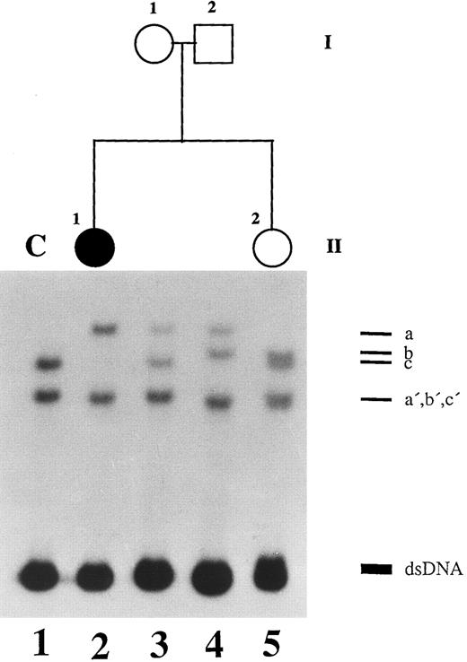 Fig. 3. SSCP analysis of plasminogen gene exon 15 in patient 2, her healthy sister, and her parents. Radiolabeled single-stranded PCR products of plasminogen exon 15 were electrophoresed in a nondenaturing 5% polyacrylamide gel as described in Materials and Methods. Lane 1, healthy control (C); lane 2, patient 2 with ligneous conjunctivitis (II-1); lane 3, healthy mother of patient 2 (I-1); lane 4, healthy father of patient 2 (I-2); lane 5, healthy sister of patient 2 (II-2). dsDNA, double-stranded DNA.