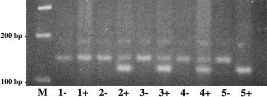 Fig. 5. Direct detection of plasminogen exon 7 mutation in family 1 by amplification mutagenesis. A part of plasminogen exon 7 containing the mutation (G → A at position 780) was amplified by PCR as described in Materials and Methods. The first primer has a single sequence mismatch that results in the introduction of an artificial BstEII restriction site into the wild-type allele only. Amplified PCR products were digested with BstEII, electrophoresed in a 2.5% agarose gel, and visualized by ethidium bromide staining. The wild-type BstEII-digested PCR fragment has a size of 119 bp, the mutant (uncut) PCR fragment has a size of 141 bp. −, No BstEII added to PCR product; +, BstEII added to PCR product. Lane M, 100-bp ladder; lane 1, patient 1; lane 2, mother of patient 1; lane 3, father of patient 1; lane 4, sister of patient 1; lane 5, healthy control. The larger (mutant) allele is found after BstEII-digestion in patient 1 (lane 1+), both parents (lanes 2+ and 3+, heterozygotes) and the sister (lane 4+, heterozygote), but not in the healthy control (lane 5+).