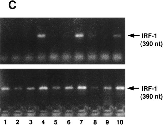 Fig. 4. (A) IFN-γ hypersensitivity and fas priming in progenitors from an FA-C child. All values represent mean clonal growth ± SD. Parallel studies with the same reagents were performed using BM CD34+ cells from a normal volunteer (B). Neither the agonistic nor the blocking anti-fas antibodies influence clonal growth of CD34+ cells from normal volunteers. IFN-γ (0.05 ng/mL) had no effect (nor has it had an effect in more than 15 separate studies in normal volunteers). As was the case in the FA mice, the fas pathway was primed in progenitors from the child. Specifically, the agonistic antibody suppressed clonal growth and the blocking antibody enhanced clonal growth of both CFU-GM (▪) and BFU-E (□). Moreover, both BFU-E and CFU-GM were suppressed by IFN-γ exposure and the suppressive effect of IFN-γ was blocked completely by the exposure of CD34+ cells to the blocking antihuman fas antibody. (C) IRF-1 mRNA is expressed constitutively by BM cells from an FA-C child. CD34+ low-density BM cells were exposed to IFN-γ at concentrations of 0.5 ng/mL (lanes 3, 6, and 9) and 50 mg/mL (lanes 4, 7, and 10) for 2 hours (lanes 2, 3, and 4), 6 hours (lanes 5, 6, and 7), and 24 hours (lanes 8, 9, and 10). Lane 1 is a zero time point control (RNA isolated at time zero with no IFN-γ exposure), and lanes 2, 5, and 8 are zero IFN-γ controls at 2, 6, and 24 hours, respectively. The upper set of lanes show IRF-1 amplification from CD34− BM cells from a normal volunteer, and the lower set of lanes show IRF-1 amplification from CD34− BM cells from an FA-C child.