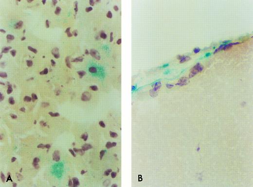 Fig. 5. β-Gal expressing ROSA 26 donor cell engraftment in the lung and brain of B6/129 F2 animals 1 month after transplantation. Only rare β-gal–expressing cells are found in the lung (A) or brain (B) of B6/129 F2 animals by 1 month following transplantation with ROSA 26 BM. The positive cells shown in (B) are seen in a leptomeningeal site. No positive cell was seen in any site in tissues from animals transplanted with control BM. These pictures were selected to document the few positive cells at these sites.