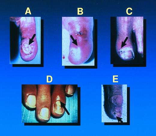 Fig. 1. Primary fusarial skin lesions: Cellulitis at the site of a wound (A) or at the site of a pre-existing onychomycosis (B-E) with surrounding cellulitis.