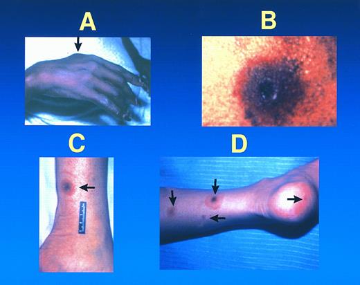 Fig. 2. Metastatic fusarial skin lesions tend to evolve from a subcutaneous nodule (A), to a necrotic lesion with a central ulcer and surrounding cellulitis (B), rarely surrounded by a thin rim of erythema (ie, a target lesion) (C). At times, lesions of different ages coexist in the same patient (D).