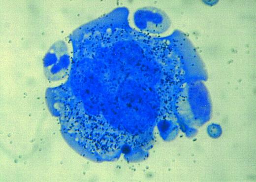 Fig. 4. Autoradiographic analysis of 125I-SCF binding to a normal human megakaryocyte. A multitude of grains is associated with the megakaryocyte, indicating that these cells display the c-kit receptor.