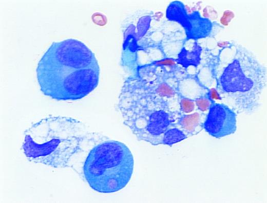 Erythrophagocytosis in myelomatous pleural effusion. A 59-year old woman with advanced multiple myeloma (IgG,κ) and ischemic heart disease presented with congestive heart failure and pancytopenia. A pleural effusion was noted on initial examination and persisted despite diuresis. A diagnostic thoracentesis was performed. The cytospin preparation demonstrated erythrophagocytosis by dysplastic plasma cells and macrophages. (Wright's stain; original magnification ×1,000.) (Courtesy of Larry L. Frase, MD, Joseph Newman, PhD, Martin L. Hurst, MD, and Marvin J. Stone, MD, Baylor-Sammons Cancer Center, Dallas, TX 75246.)